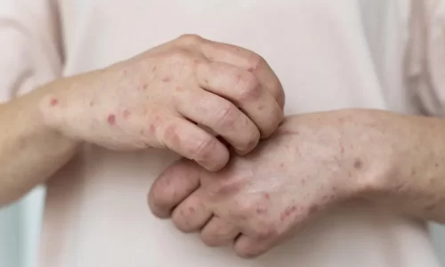 Casos confirmados de Mpox aumentam para 35 no Amazonas, aponta FVS
