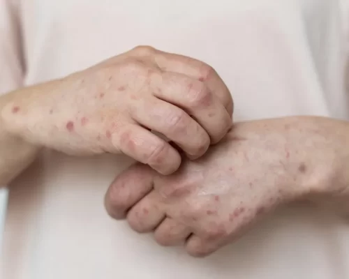 Casos confirmados de Mpox aumentam para 35 no Amazonas, aponta FVS